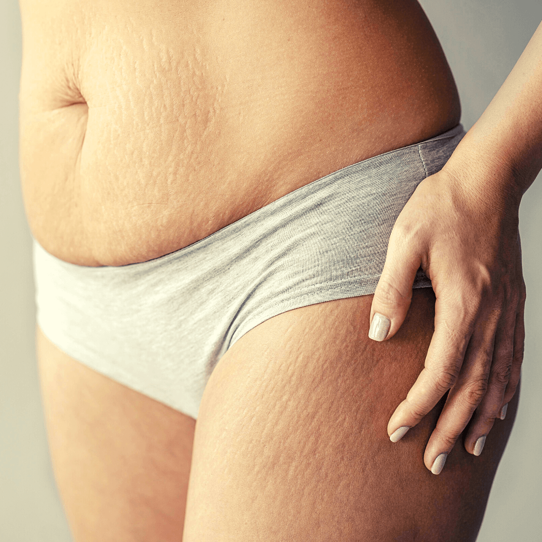 Trucos y consejos para quitar cicatrices y estrías